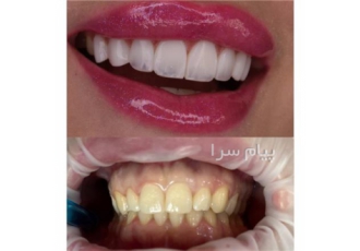 کامپوزیت و لمینت دندان در خیابان شریعتی تهران کامپوزیت و لمینت دندان